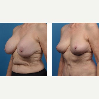 65 year old woman treated with Breast Implant Removal after 2524200