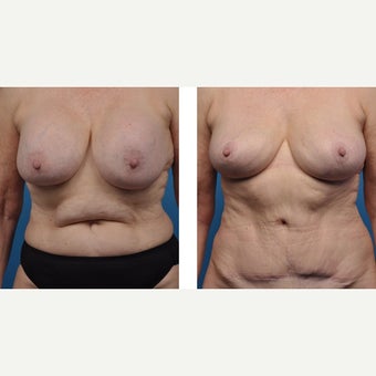 65 year old woman treated with Breast Implant Removal before 2524200