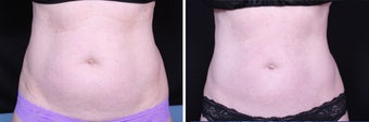 CoolSculpting Front View before 1135154