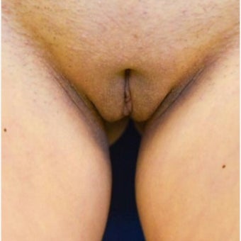 25-34 year old woman treated with Labiaplasty and Clitoral Hood Reduction after 2416926