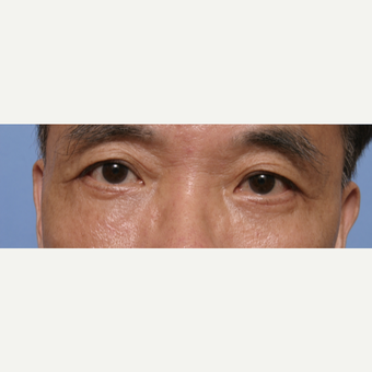 55-64 year old man treated with Eye Bags Treatment after 3135591