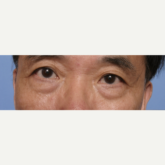 55-64 year old man treated with Eye Bags Treatment before 3135591
