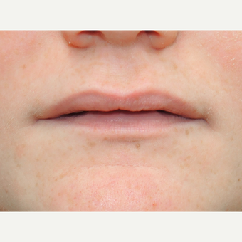 18-24 year old woman treated with Lip Augmentation before 3169854