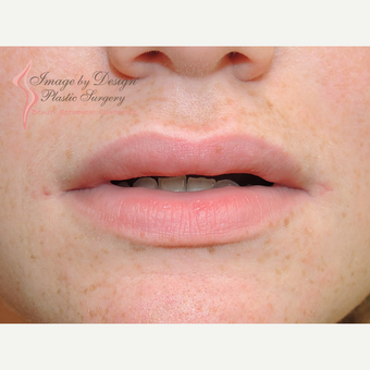 18-24 year old woman treated with Lip Augmentation after 3169854