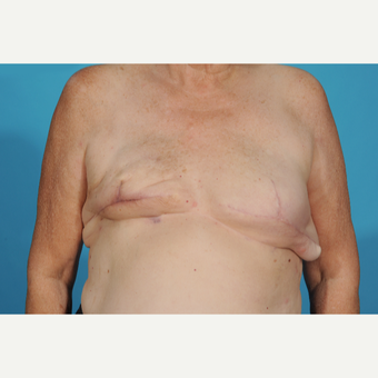 59 year old woman treated with Breast Reconstruction before 3097717