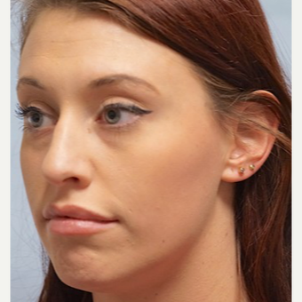 25-34 year old woman treated with Lip Augmentation after 3716290