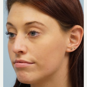 25-34 year old woman treated with Lip Augmentation before 3716290