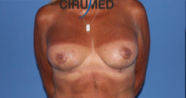 Mastopexy with vertical scar and teardrop implants after 3053593