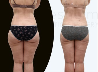 37 year old women body jet liposuction to remove fat and shaping of thighs before 1127698
