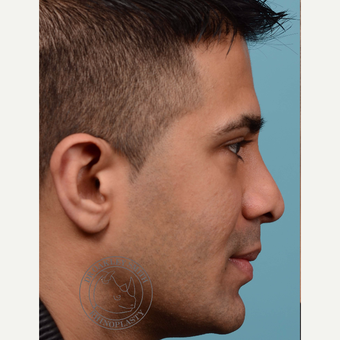35-44 year old man treated with Revision Rhinoplasty before 3092655