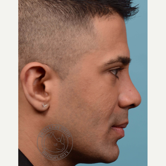 35-44 year old man treated with Revision Rhinoplasty after 3092655