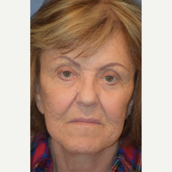 76 year old female treated with cheek lift before 3245894