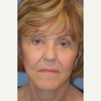 76 year old female treated with cheek lift after 3245894