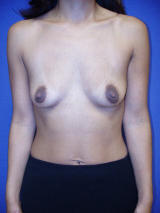 Breast Augmentation Surgery before 103738