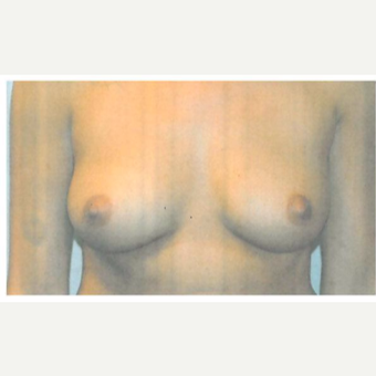 18-24 year old woman treated with Breast Augmentation before 3103118