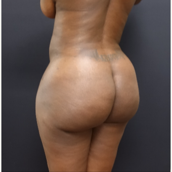 35-44 year old woman treated with Fat Transfer after 3200931