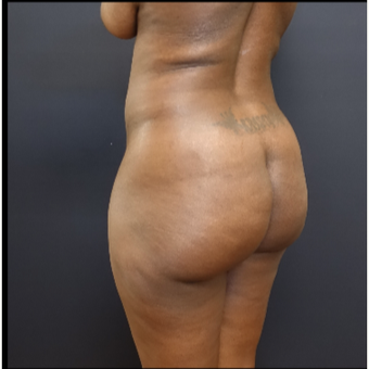 35-44 year old woman treated with Fat Transfer before 3200931