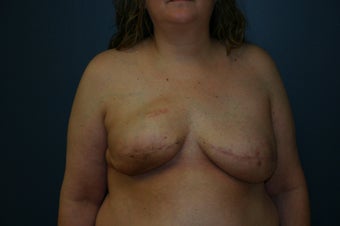 Breast Reconstruction after mastectomy before 1104916