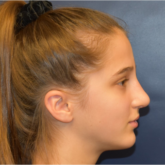 17 or under year old woman treated with Septoplasty after 3306033
