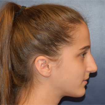 17 or under year old woman treated with Septoplasty before 3306033