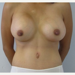 Mommy Makeover after 2994622