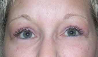 Blepharoplasty after 611308