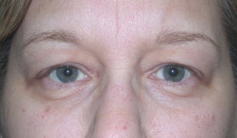 Blepharoplasty before 611308