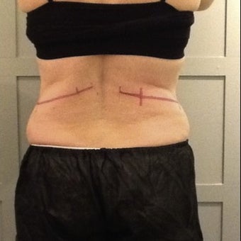 CoolSculpting for Mother of Five before 1716805