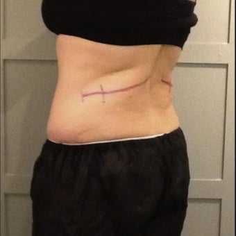 CoolSculpting for Mother of Five 1716805