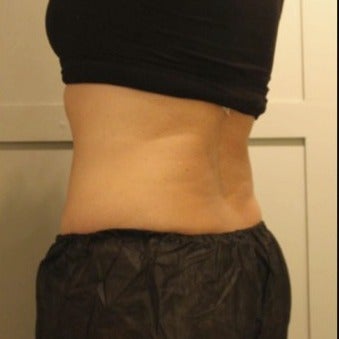 CoolSculpting for Mother of Five 1716805