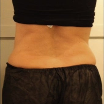 CoolSculpting for Mother of Five after 1716805