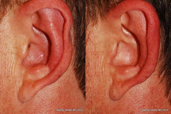 Ear Surgery before 1445744