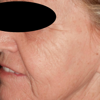 65-74 year old woman treated with Filler and Resurfacing Laser Treatment before 3183889