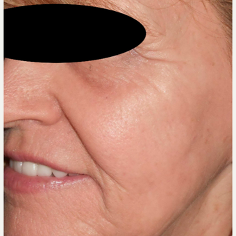 65-74 year old woman treated with Filler and Resurfacing Laser Treatment after 3183889