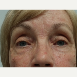 65-74 year old woman treated with Restylane Lyft after 2943150