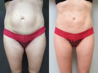 35-44 year old woman treated with Liposuction before 3299773