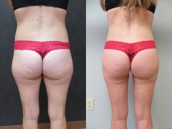 35-44 year old woman treated with Liposuction 3299773