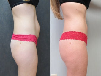 35-44 year old woman treated with Liposuction after 3299773