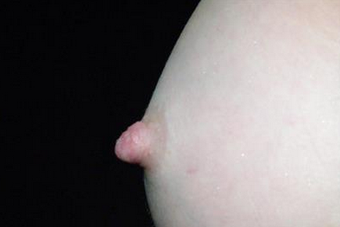 35-44 year old woman treated with Nipple Surgery after 1677449
