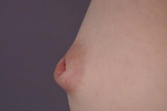 35-44 year old woman treated with Nipple Surgery before 1677449