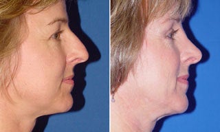 Rhinoplasty before 1306437