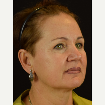 Neck Band improvement and Tightening of the smile lines – Novathreads before 3583092