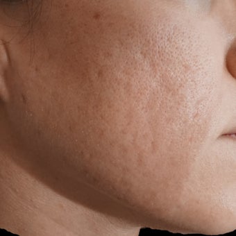 25-34 year old woman treated with Bellafill before 1864357