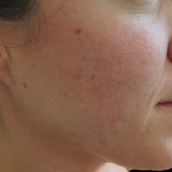 25-34 year old woman treated with Bellafill after 1864357