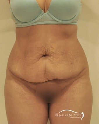 Extended Tummy Tuck before 3000888