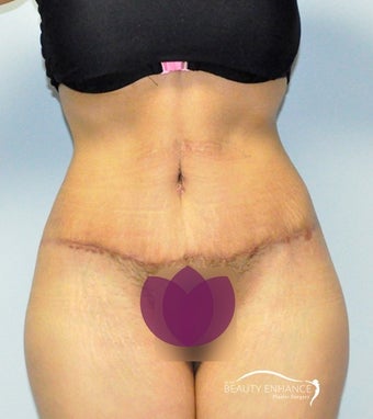 Extended Tummy Tuck after 3000888
