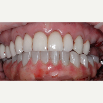 Day of surgery results - CT Guided EVERYTHING after 2791050