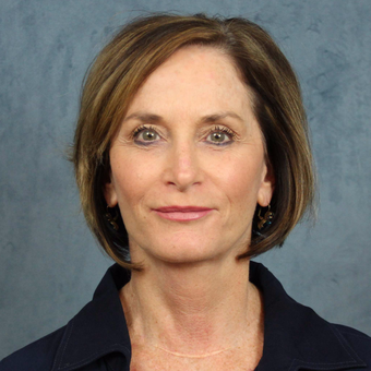55-64 year old woman treated with Facelift Revision after 2723751