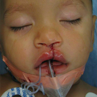 Cleft Lip And Palate Repair after 3711065