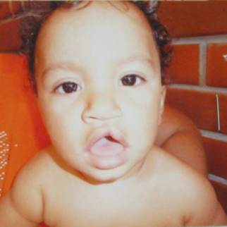 Cleft Lip And Palate Repair before 3711065